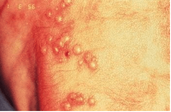 عدوى بفيروس الهربس البسيط لحديثي الولادة من موقع أدلة MSD
